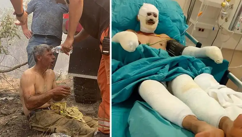 Orman İşçisinin Yanık Tedavisi Devam Ediyor: Sağlık Durumu Nasıl?