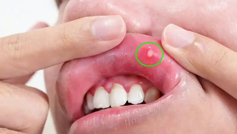 Vücudunuzun İhtiyaç Duyduğu 5 B Vitamini Eksikliği Belirtisi